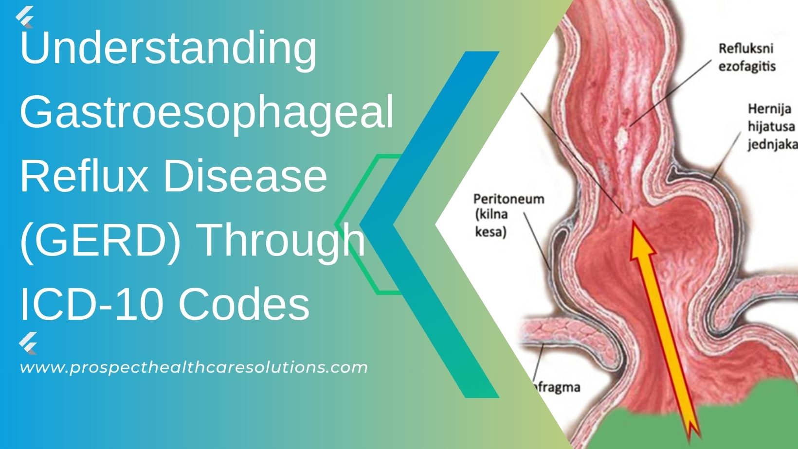 gastroesophageal reflux disease (gerd) icd 10