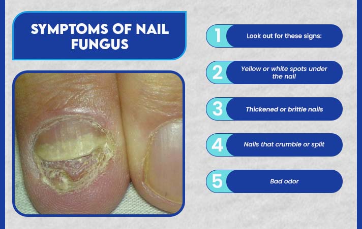onychomycosis icd 10 | A Guide to Nail Fungus and ICD-10 3 Symptoms of Nail Fungus