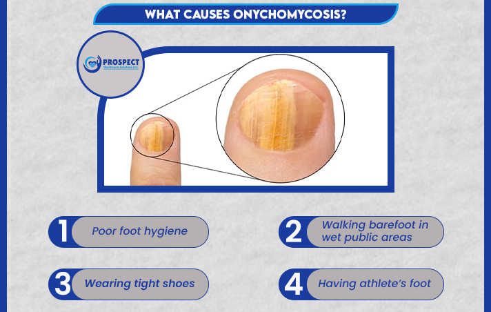 onychomycosis icd 10 | A Guide to Nail Fungus and ICD-10 2 What Causes onychomycosis